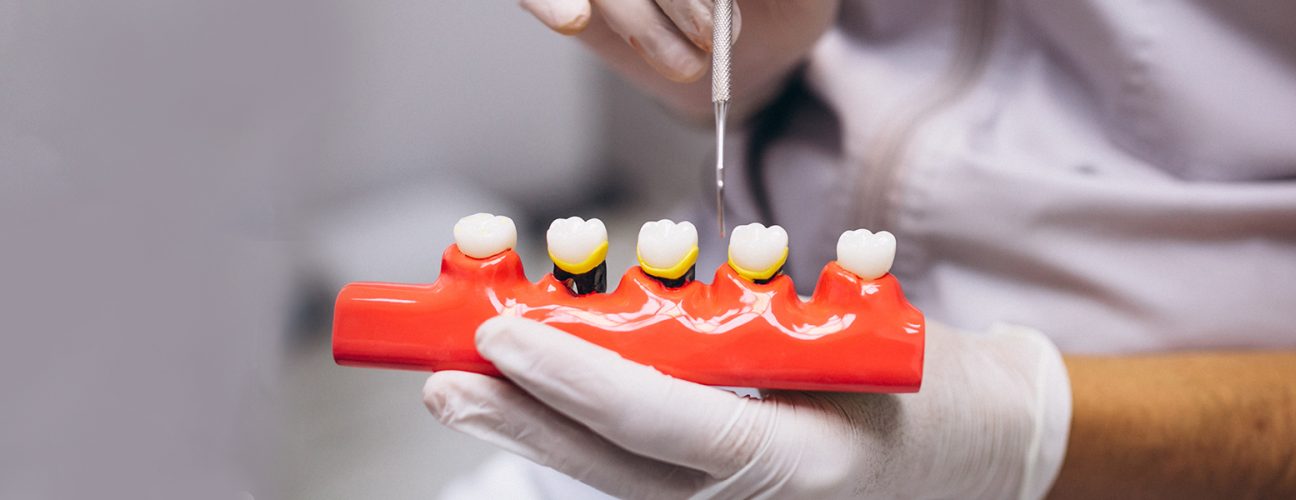 Expert Dental Implant Services by Dr. Hugh B. Rosenblatt in Boynton Beach