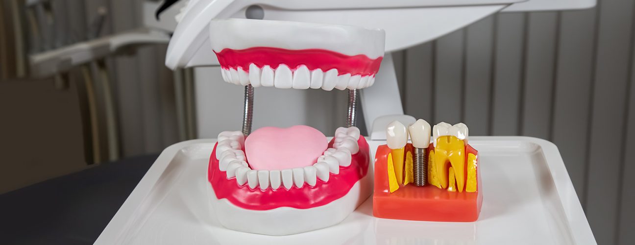Top 5 Questions to Ask Before Getting Dental Implants in Boynton Beach